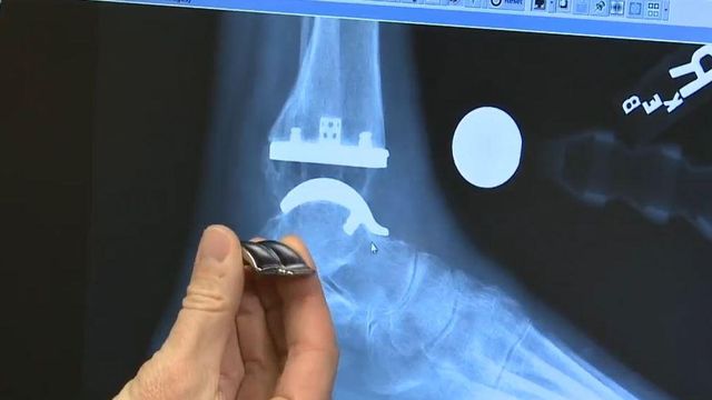 Duke develops easier, more durable ankle replacement procedure