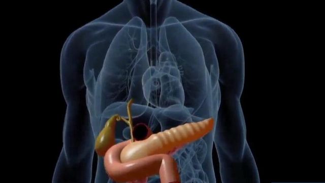 New procedure offers hope for pancreaticcystosis patients