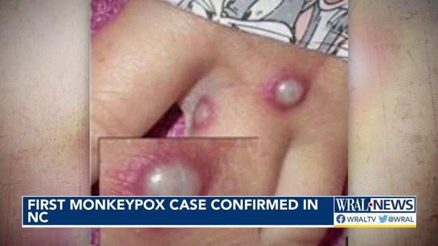 Wake County health leaders investigating first monkeypox case