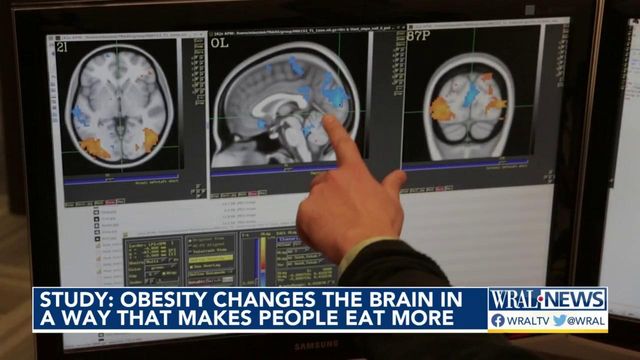 Study: Obesity changes the brain in a way that makes people eat more