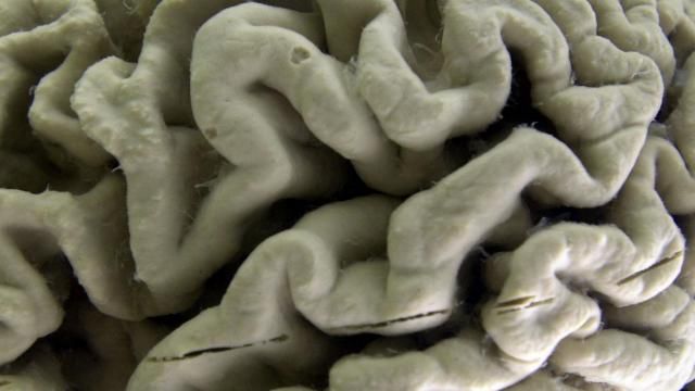 FILE - A closeup of a human brain affected by Alzheimer's disease, is displayed at the Museum of Neuroanatomy at the University at Buffalo in Buffalo, N.Y., on Oct. 7, 2003. According to findings published Wednesday, Feb. 21, 2024 in the New England Journal of Medicine, Alzheimer’s quietly ravages the brain long before symptoms appear and now scientists are getting a closer look at the domino-like sequence of those changes _ a potential window to one day intervene. (AP Photo/David Duprey) FILE - A closeup of a human brain affected by Alzheimer's disease, is displayed at the Museum of Neuroanatomy at the University at Buffalo in Buffalo, N.Y., on Oct. 7, 2003. According to findings published Wednesday, Feb. 21, 2024 in the New England Journal of Medicine, Alzheimer’s quietly ravages the brain long before symptoms appear and now scientists are getting a closer look at the domino-like sequence of those changes _ a potential window to one day intervene. (AP Photo/David Duprey)