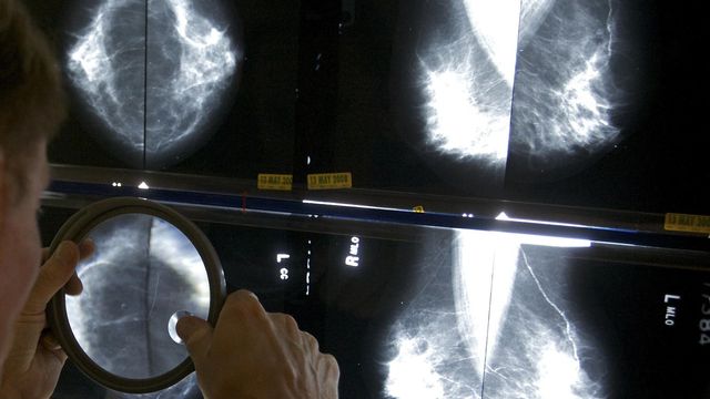 New guidance: Breast cancer screening should begin at 40