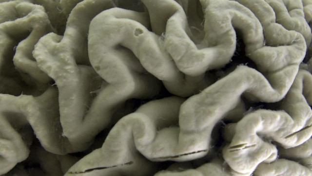 FILE - A section of a human brain with Alzheimer's disease is displayed at the Museum of Neuroanatomy at the University at Buffalo, in Buffalo, N.Y., Oct. 7, 2003. A long-feared gene appears to do more than raise people’s risk of Alzheimer’s: Inheriting two copies can cause the mind-robbing disease, according to research published in the journal Nature Medicine on Monday, May 6, 2024. (AP Photo/David Duprey, File) FILE - A section of a human brain with Alzheimer's disease is displayed at the Museum of Neuroanatomy at the University at Buffalo, in Buffalo, N.Y., Oct. 7, 2003. A long-feared gene appears to do more than raise people’s risk of Alzheimer’s: Inheriting two copies can cause the mind-robbing disease, according to research published in the journal Nature Medicine on Monday, May 6, 2024. (AP Photo/David Duprey, File)