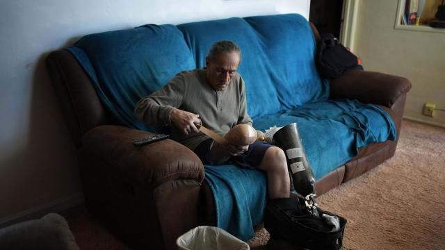 Blas Sanchez prepares to put on a prosthetic Friday, Jan. 26, 2024, in Winslow, Ariz.Sanchez's leg was mutilated while working near the chicken manure chute as a prison laborer at Hickman's Family Farms in 2015 in Tonopah, Ariz. (AP Photo/John Locher)