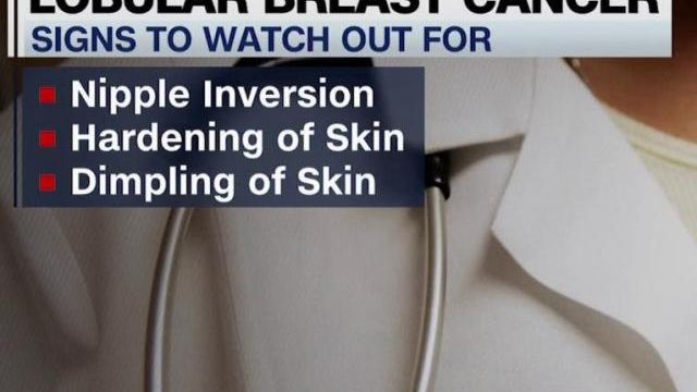Cases of lesser-known breast cancer type on rise
