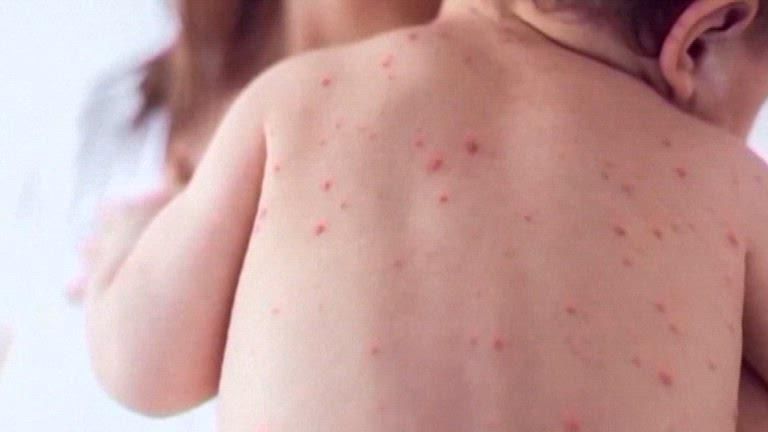 South Carolina measles outbreak surpasses Texas' 2025 total, with little sign of slowing