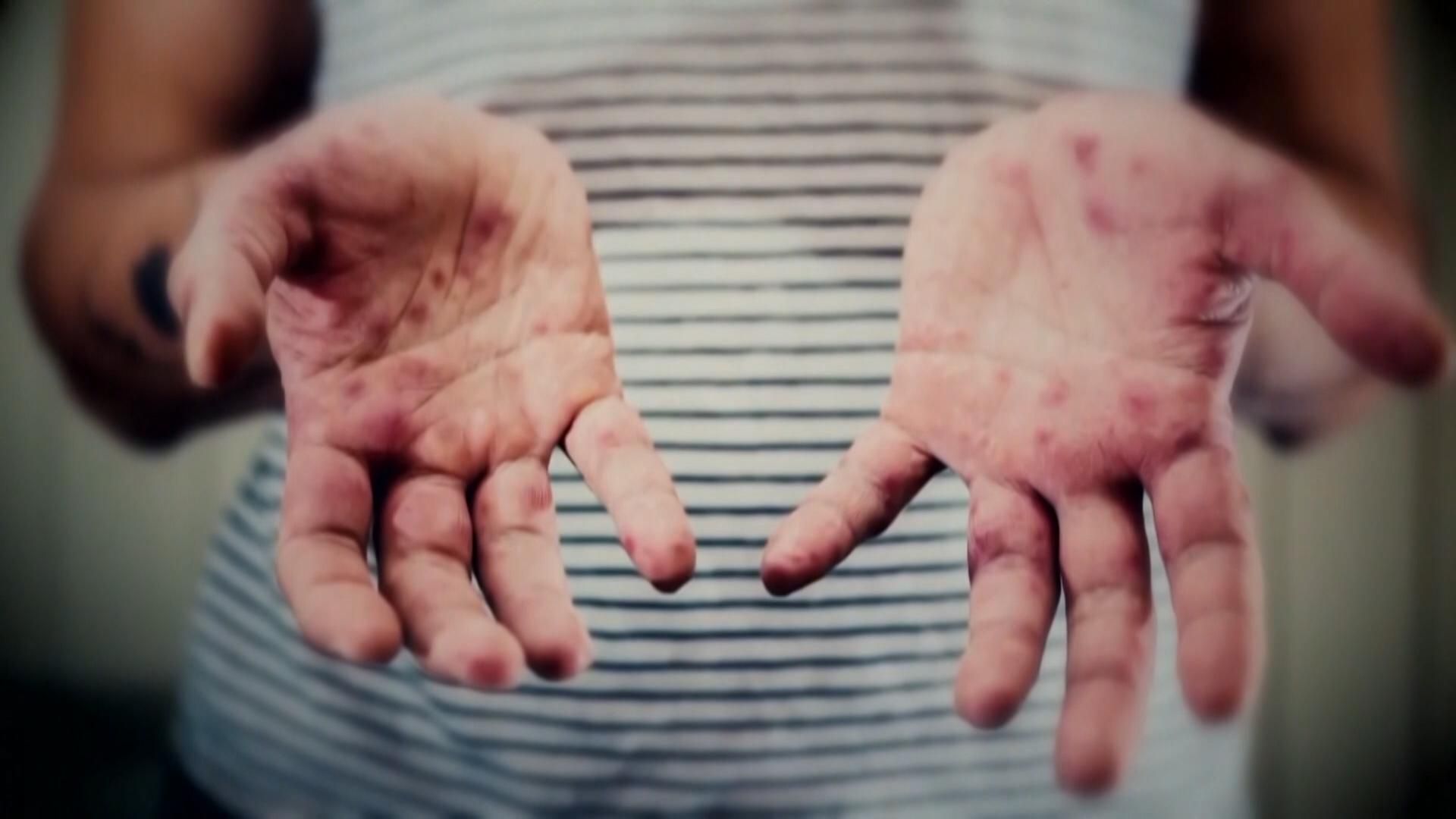 Q&A: What to know about the measles outbreak, and how to protect yourself in NC