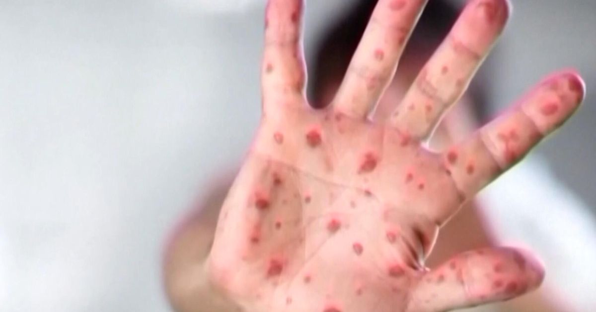 Measles case reported in Johnston County as North Carolina total rises to 21