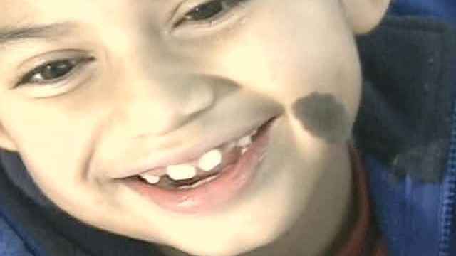 Boy Gets New Prosthetic Eye, Thanks to Donors