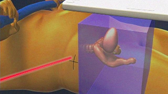 Device offers new option to treat prostate cancer