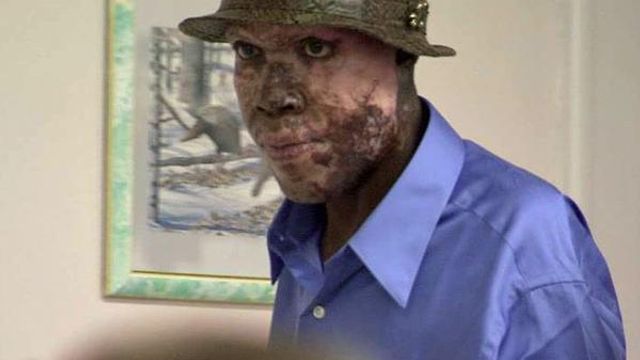 Local Haitians inspired by burn victim's recovery