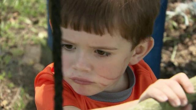 Sampson 3-year-old recovers from pit bull attack