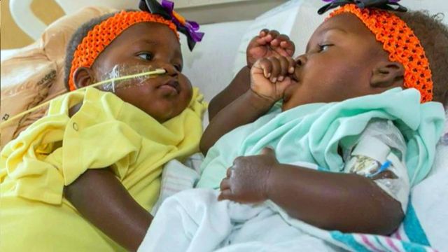 Conjoined twins travel from Uganda to US for successful separation