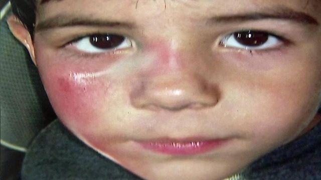 Dad says daycare worker caused bruises, scabs when washing son's face