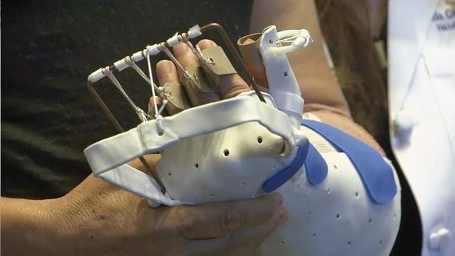 Duke surgical team celebrates historic hand transplant surgery