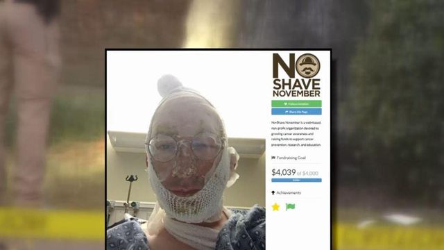 Injured professor participates in 'No-Shave November'