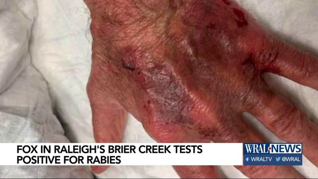 Brier Creek man recieving treatment after rabid fox bite