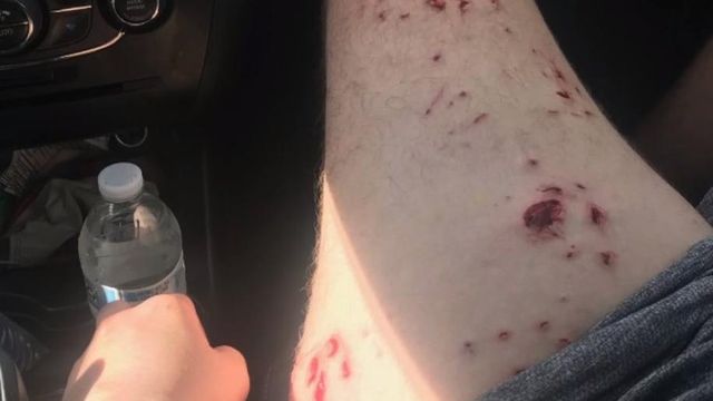 NC teen bitten by shark, family describes the attack 