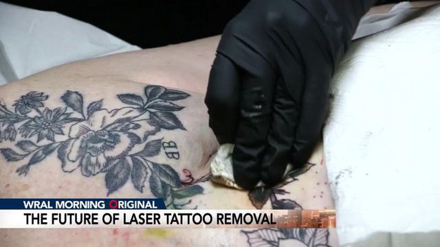 Duke improving tattoo removal process