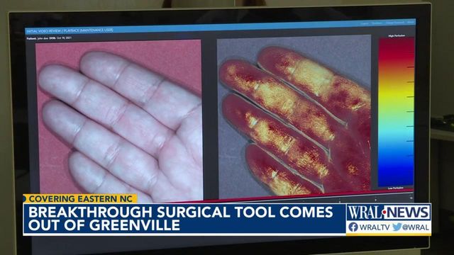 Greenville medical startup develops device that can see blood through through skin