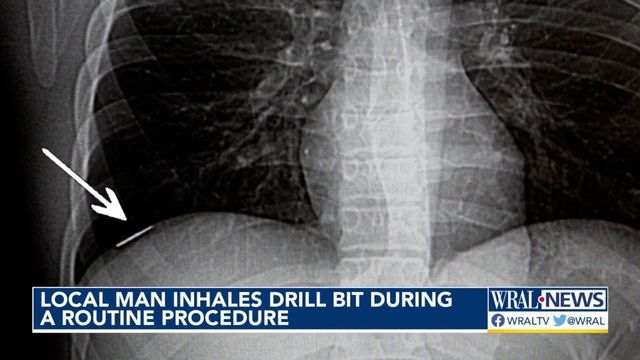 Man inhales drill bit during routine dental procedure 