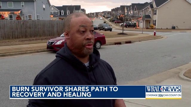 Burn survivor raising money for counseling as part of healing process