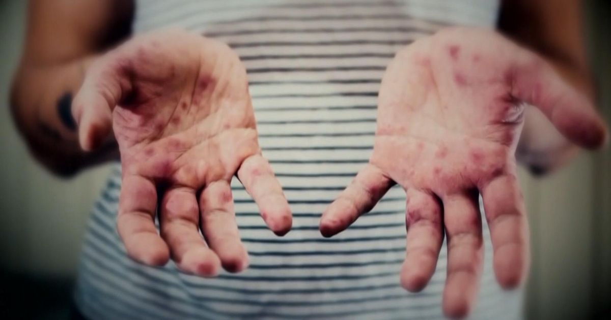 Measles exposure: Person with measles visited five Raleigh locations while contagious, officials say