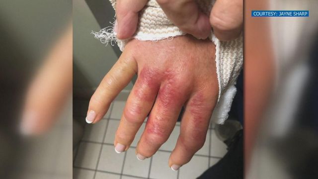Woman said she contracted flesh-eating bacteria at nail salon