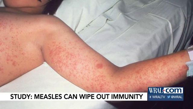 Study says measles can give your body 'immune amnesia'