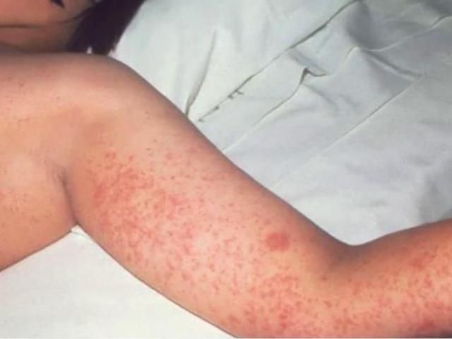 Measles Is A Renewed Global Threat After 22 Million Babies Missed Their ...