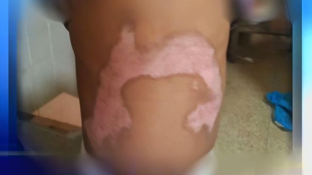 5-year-old badly burned during school science experiment