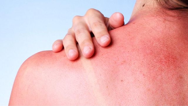 Skin cancer: Separating fact from fiction 