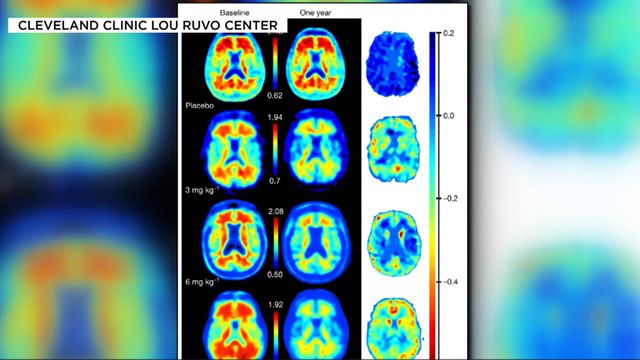New drug appears to slow Alzheimer's Disease