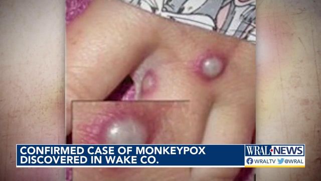 More monkeypox cases likely in Wake County, infectious disease specialist says 