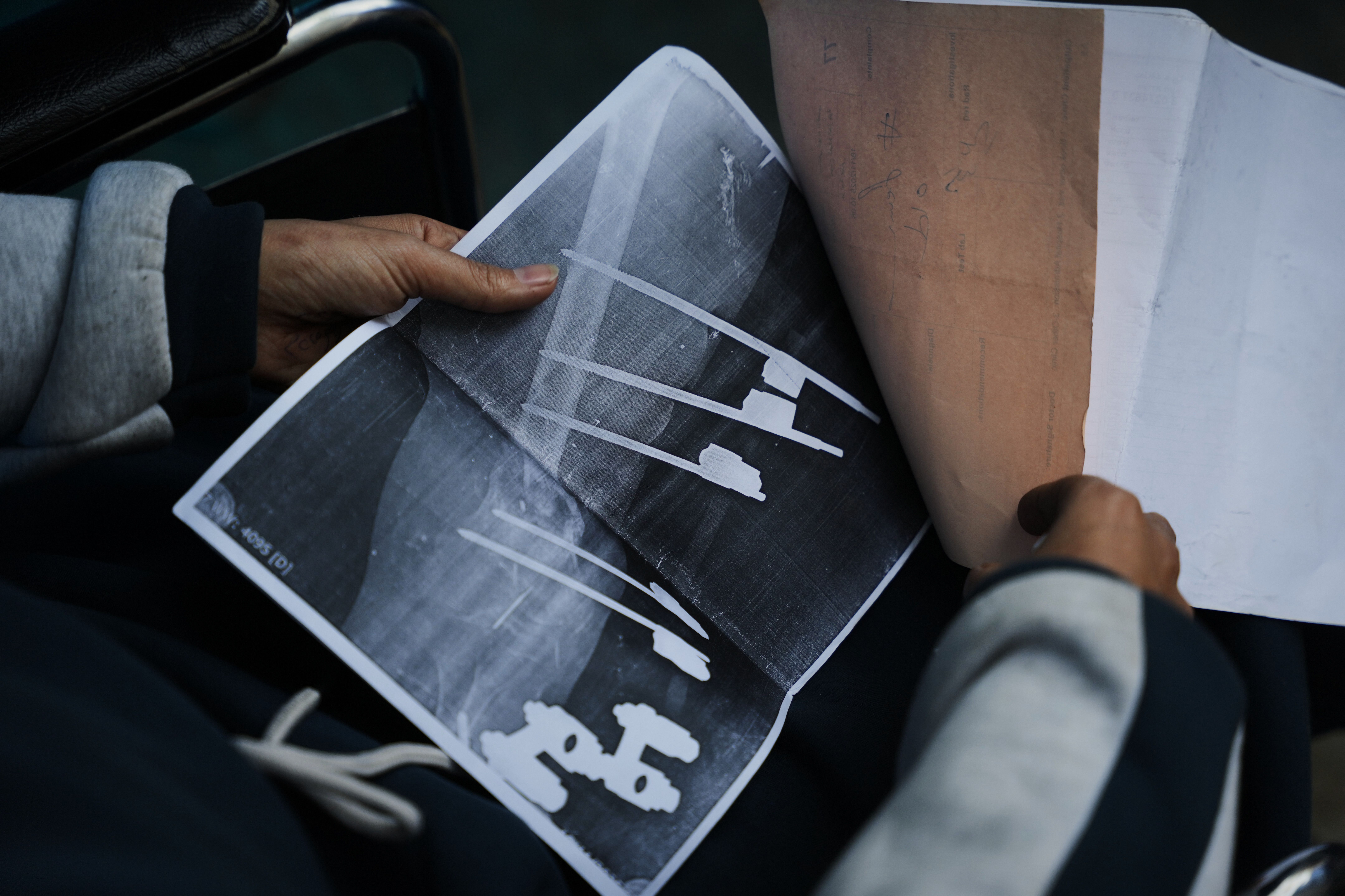 A bullet shattered her knee . Now a Gaza teen chances of walking depend on Rafah border crossing